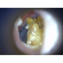earscope-2-500x500